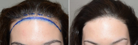Forehead Reduction Surgery Before and after in Miami, FL, Paciente 123551