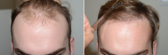 Hair Transplants for Men Before and after in Miami, FL, Paciente 123564