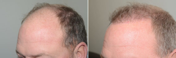 Hair Transplants for Men Before and after in Miami, FL, Paciente 123581
