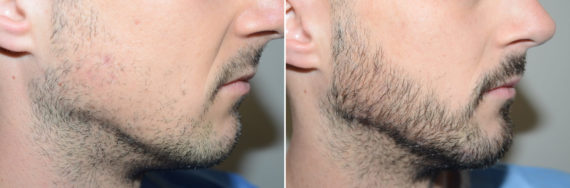 Facial Hair Transplant Before and after in Miami, FL, Paciente 123600