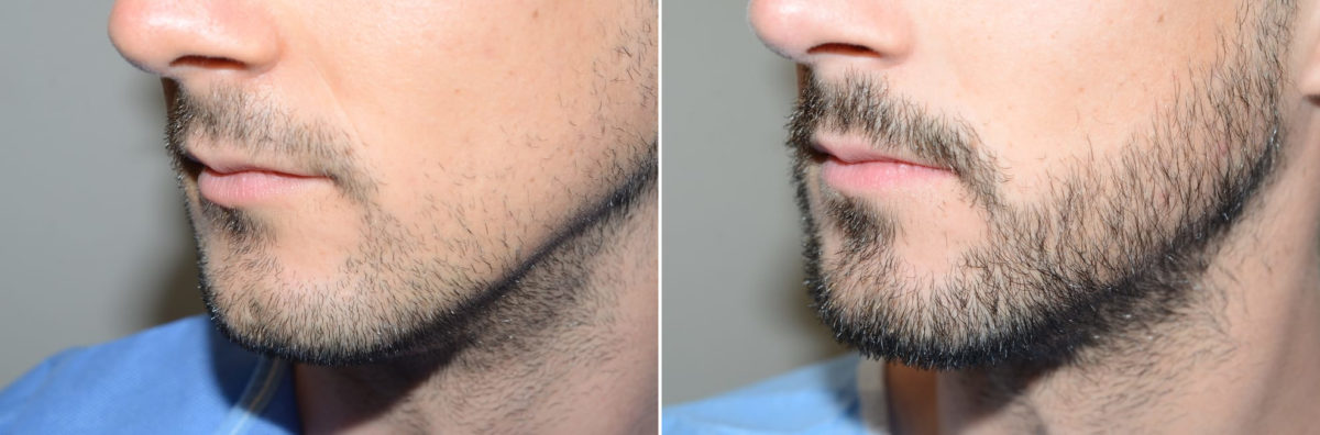 Facial Hair Transplant Before and after in Miami, FL, Paciente 123600