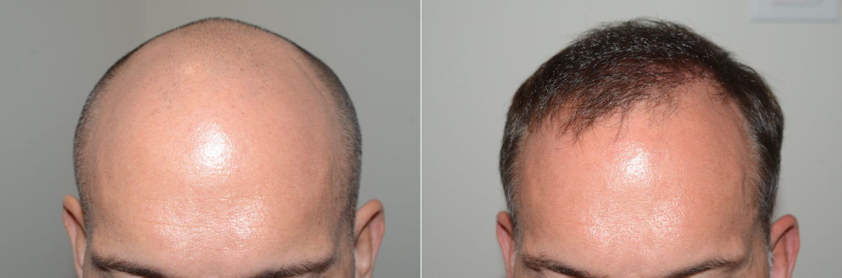 Hair Transplants for Men Before and after in Miami, FL, Paciente 123679