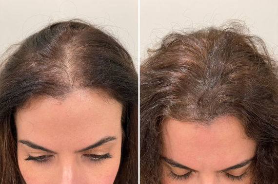 Scalp Micropigmentation Before and after in Miami, FL, Paciente 123711