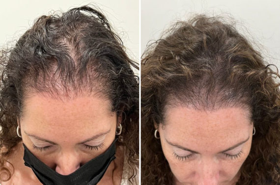 Scalp Micropigmentation Before and after in Miami, FL, Paciente 123718