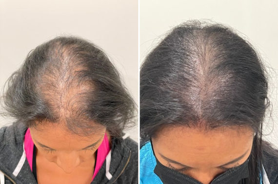 Scalp Micropigmentation Before and after in Miami, FL, Paciente 123725