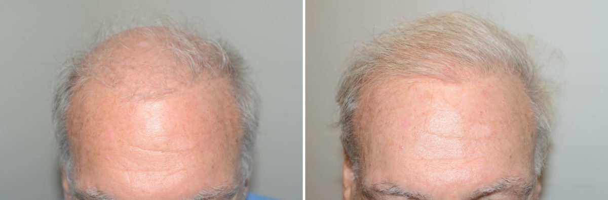 Body Hair Transplant Before and after in Miami, FL, Paciente 123760