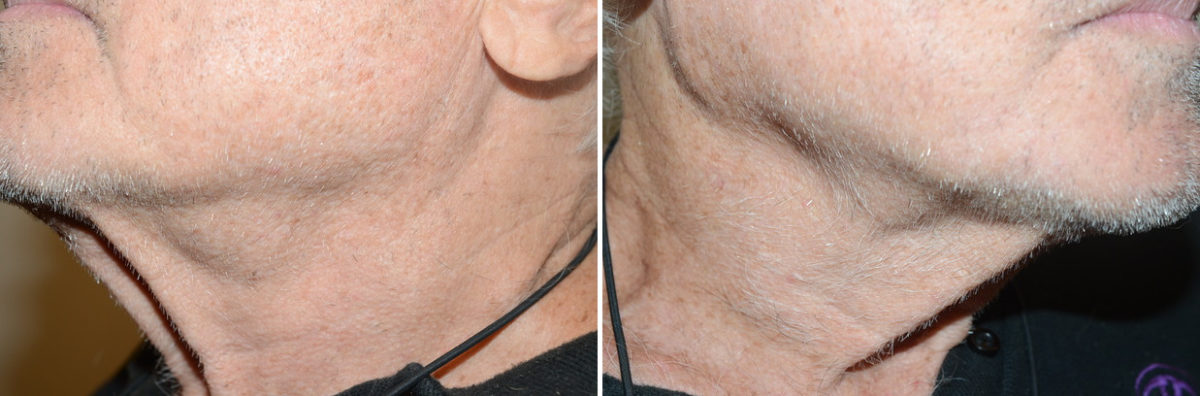 Body Hair Transplant Before and after in Miami, FL, Paciente 123760