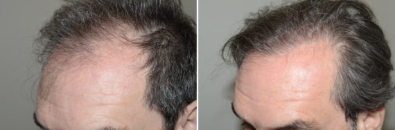 Hair Transplants for Men Before and after in Miami, FL, Paciente 123789