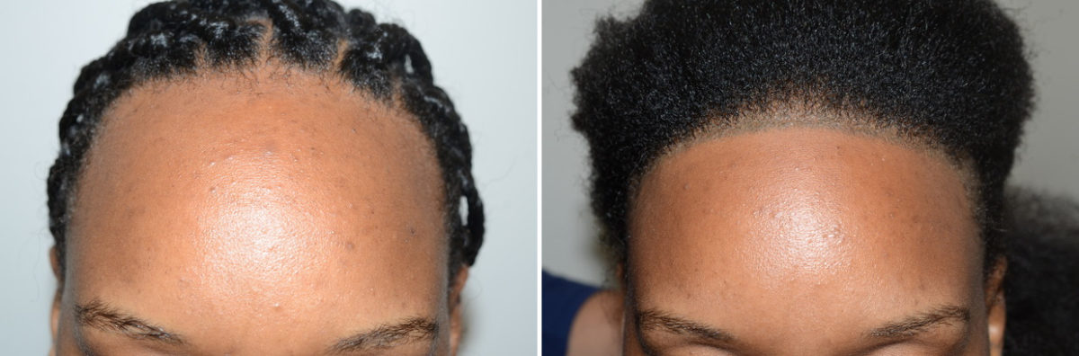 Forehead Reduction Surgery Before and after in Miami, FL, Paciente 123808