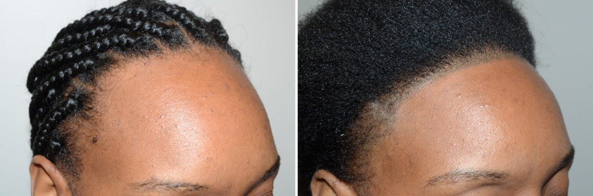 Forehead Reduction Surgery Before and after in Miami, FL, Paciente 123808