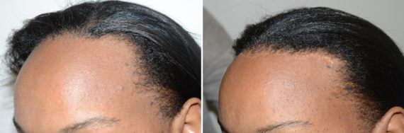 Forehead Reduction Surgery Before and after in Miami, FL, Paciente 123827