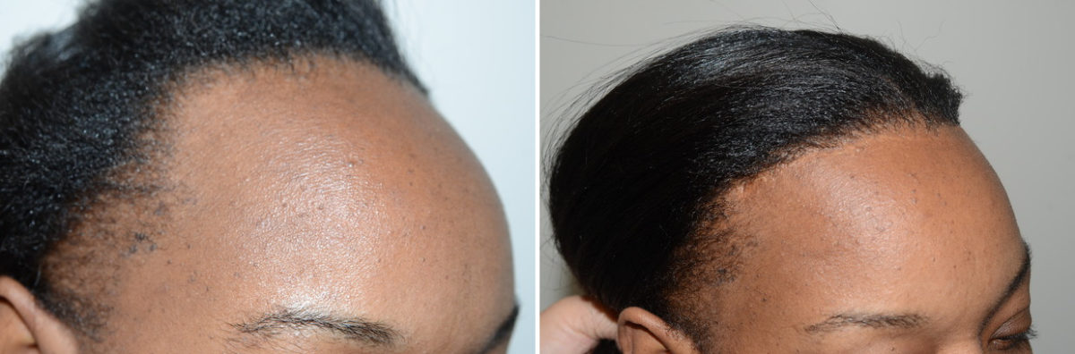 Forehead Reduction Surgery Before and after in Miami, FL, Paciente 123827