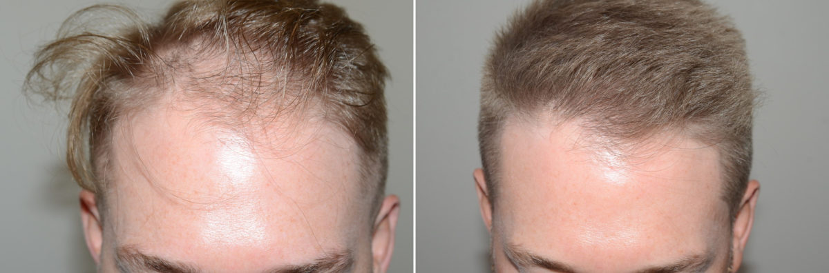 Hair Transplants for Men Before and after in Miami, FL, Paciente 123926