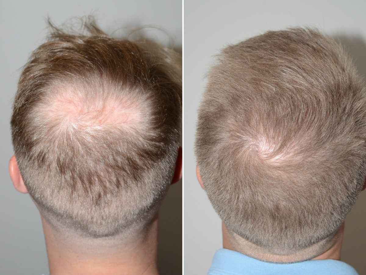 Hair Transplants for Men Before and after in Miami, FL, Paciente 123926