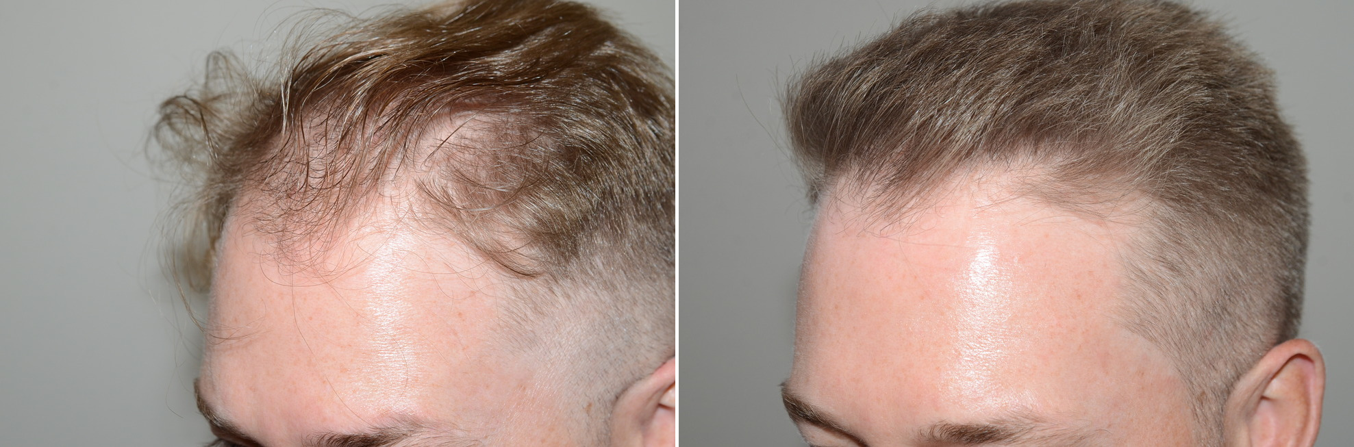 Hair Transplants for Men Before and After Photos - Foundation For Hair  Restoration