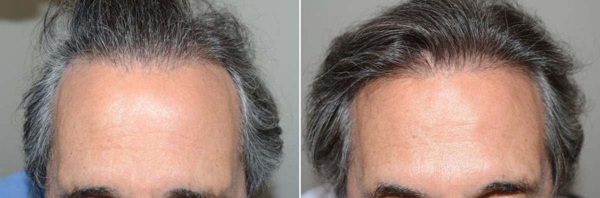 Hair Transplants for Men Before and after in Miami, FL, Paciente 123951