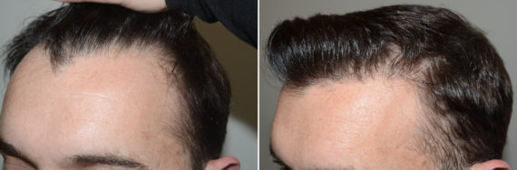 Hair Transplants for Men Before and after in Miami, FL, Paciente 123979