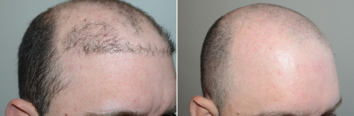 Reparative Hair Transplant Before and after in Miami, FL, Paciente 123998