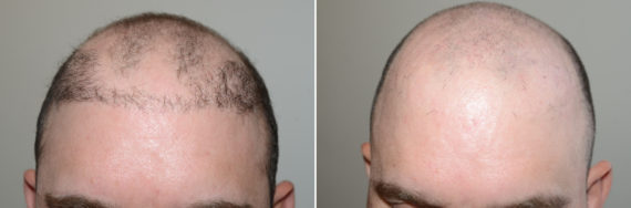 Reparative Hair Transplant Before and after in Miami, FL, Paciente 123998