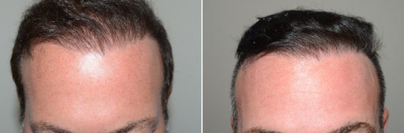 Reparative Hair Transplant Before and after in Miami, FL, Paciente 124017