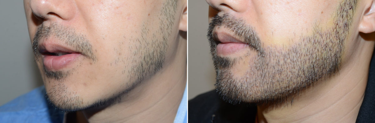 Facial Hair Transplant Before and after in Miami, FL, Paciente 124075