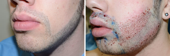 Facial Hair Transplant Before and after in Miami, FL, Paciente 36792