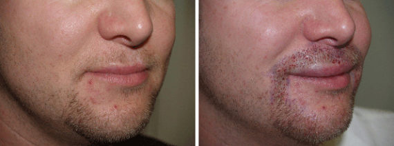 Facial Hair Transplant Before and after in Miami, FL, Paciente 36891