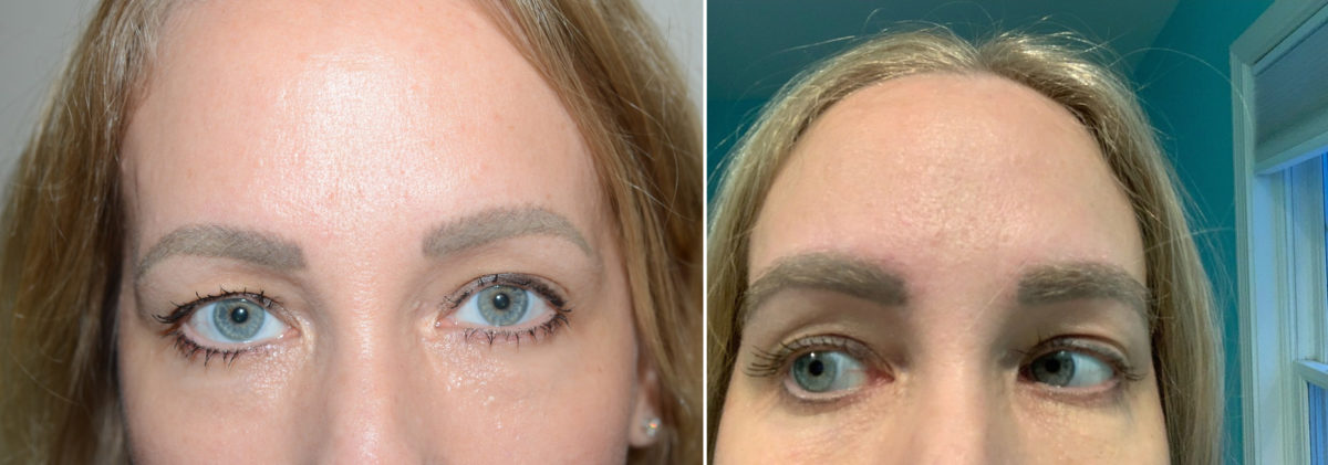 Eyebrow Hair Transplant Before and after in Miami, FL, Paciente 124110