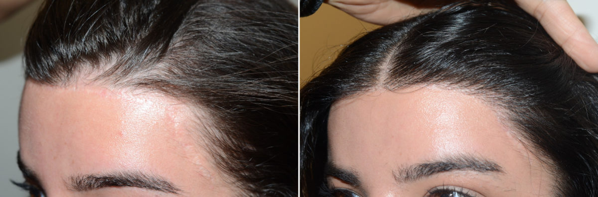 Hair Transplants for Gender Reaffirmation Before and after in Miami, FL, Paciente 124130