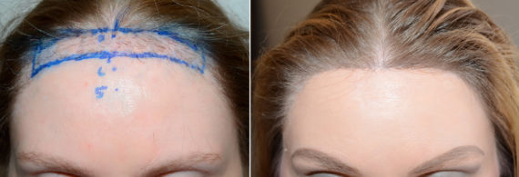 Forehead Reduction Surgery Before and after in Miami, FL, Paciente 58650