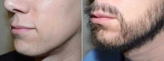Facial Hair Transplant Before and after in Miami, FL, Paciente 58871