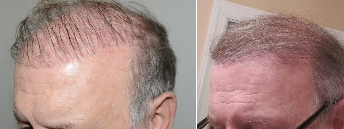 Reparative Hair Transplant Before and after in Miami, FL, Paciente 118745