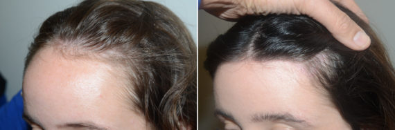 Forehead Reduction Surgery Before and after in Miami, FL, Paciente 124176