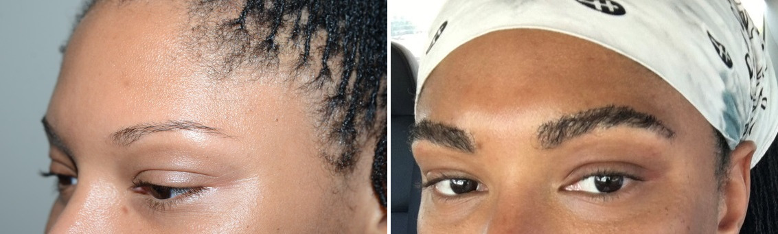 Eyebrow Hair Transplant Before and after in Miami, FL, Paciente 124206