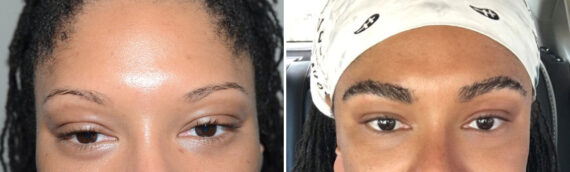 Eyebrow Hair Transplant Before and after in Miami, FL, Paciente 124206