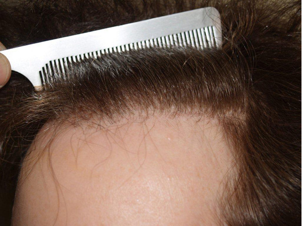 Hair Transplants for Women Before and after in Miami, FL, Paciente 41173