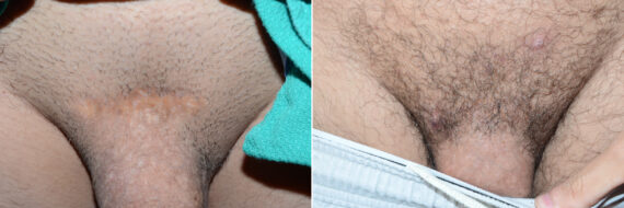 Body Hair Transplant Before and after in Miami, FL, Paciente 59206