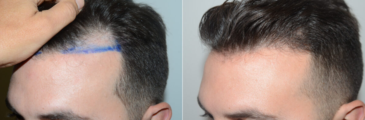 Hair Transplants for Men Before and after in Miami, FL, Paciente 123194