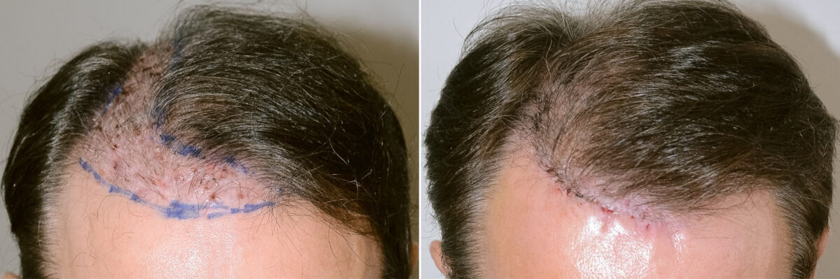 Reparative Hair Transplant Before and after in Miami, FL, Paciente 124275