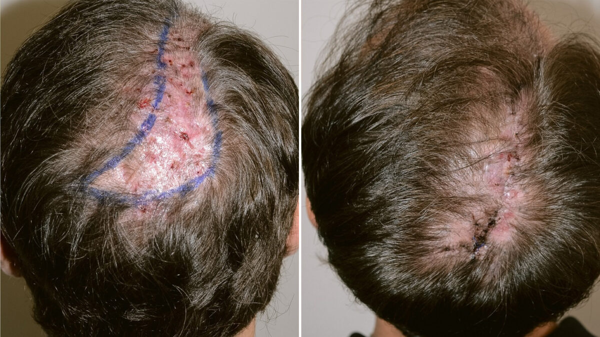 Reparative Hair Transplant Before and after in Miami, FL, Paciente 124275