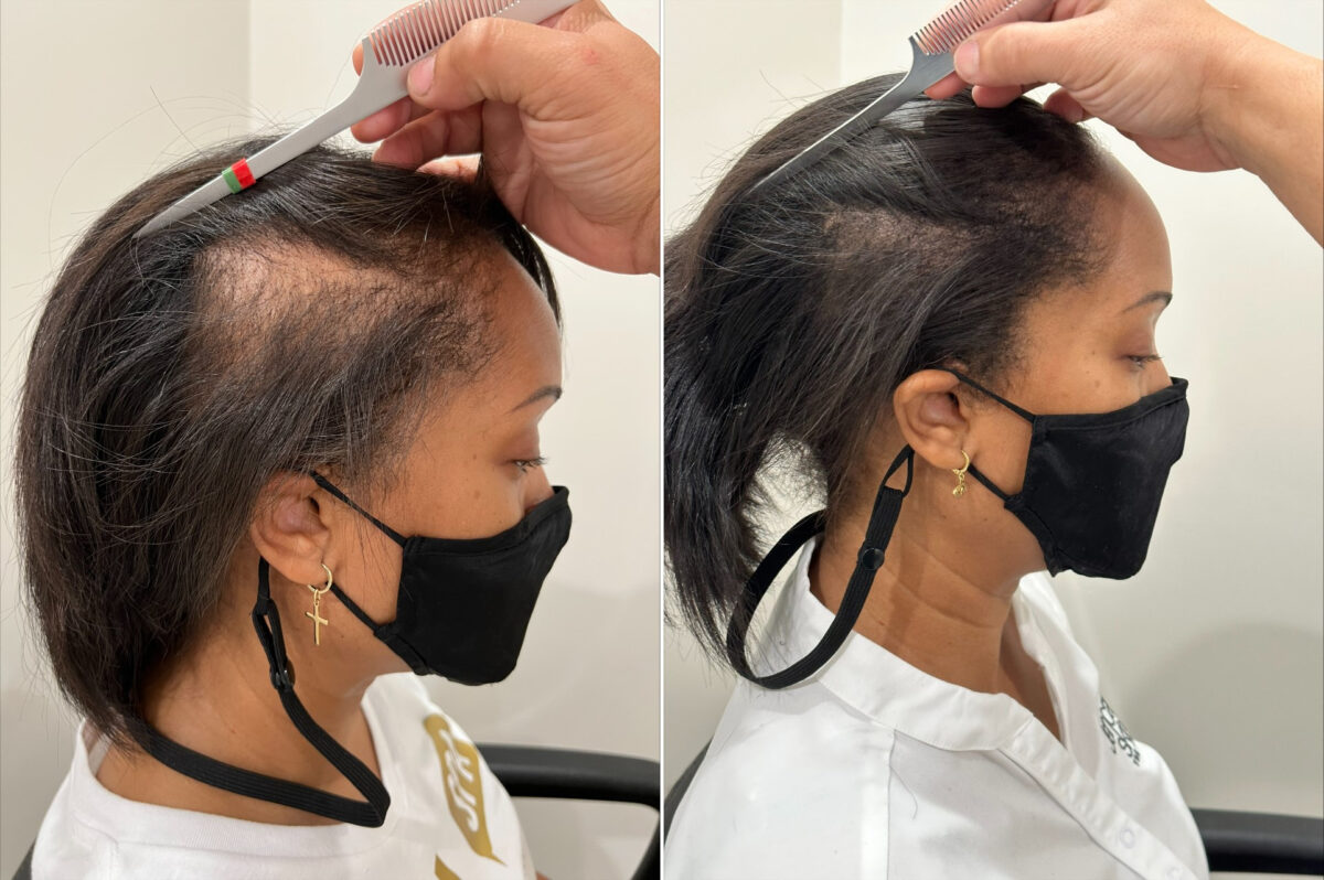 Reparative Hair Transplant Before and after in Miami, FL, Paciente 124294