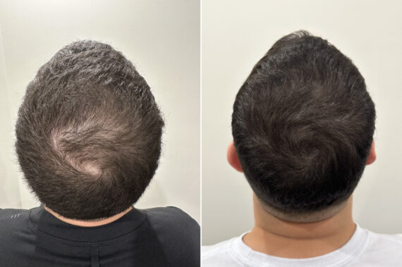 Reparative Hair Transplant Before and after in Miami, FL, Paciente 124295
