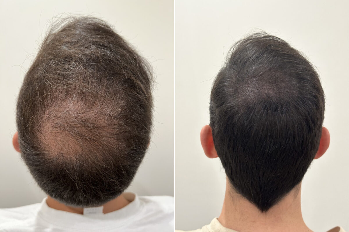 Scalp Micropigmentation Before and after in Miami, FL, Paciente 124296