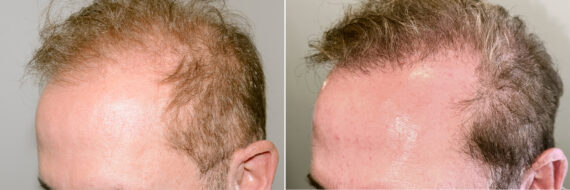 Body Hair Transplant Before and after in Miami, FL, Paciente 124315