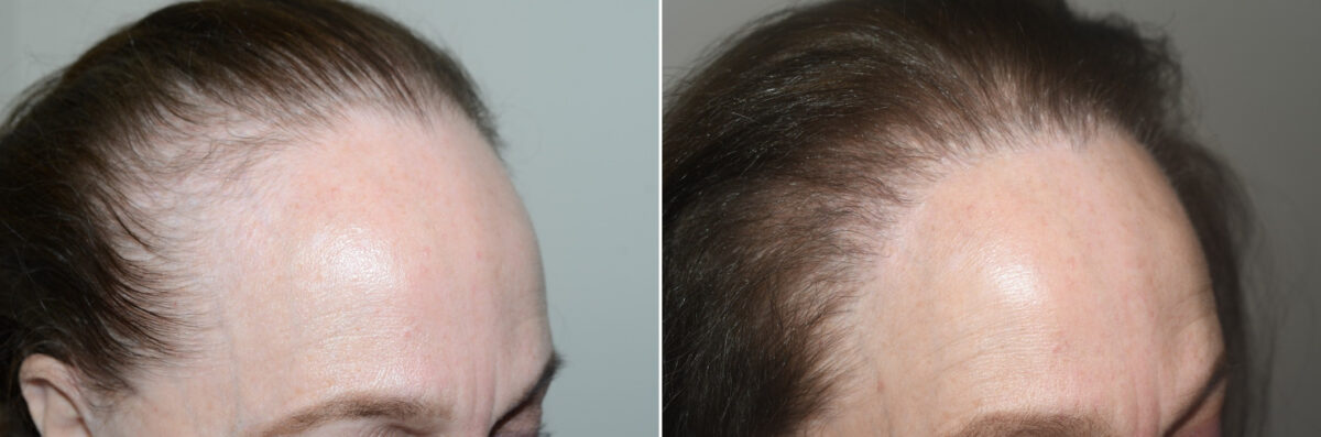 Hair Transplants for Women Before and after in Miami, FL, Paciente 124353