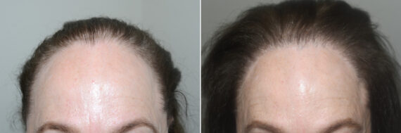 Hair Transplants for Women Before and after in Miami, FL, Paciente 124353