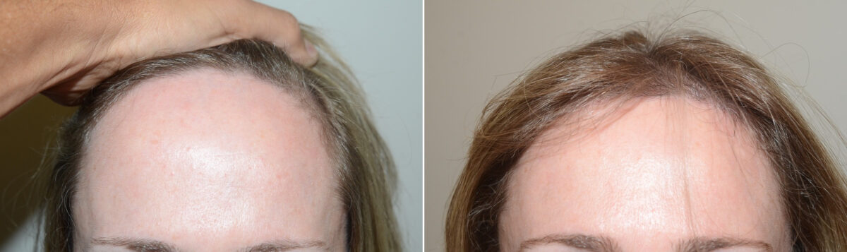 Forehead Reduction Surgery Before and after in Miami, FL, Paciente 124414