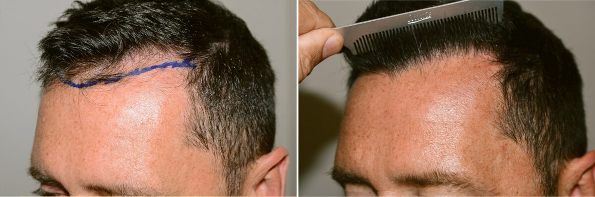 Hair Transplants for Men Before and after in Miami, FL, Paciente 124443