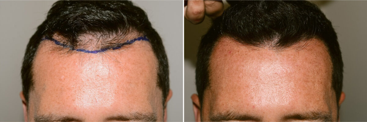 Hair Transplants for Men Before and after in Miami, FL, Paciente 124443