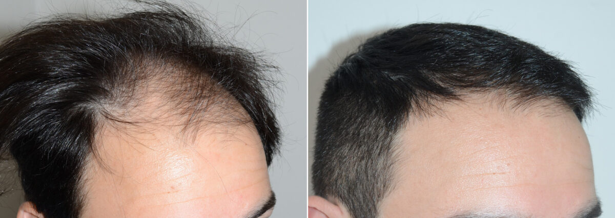 Hair Transplants for Men Before and after in Miami, FL, Paciente 107965